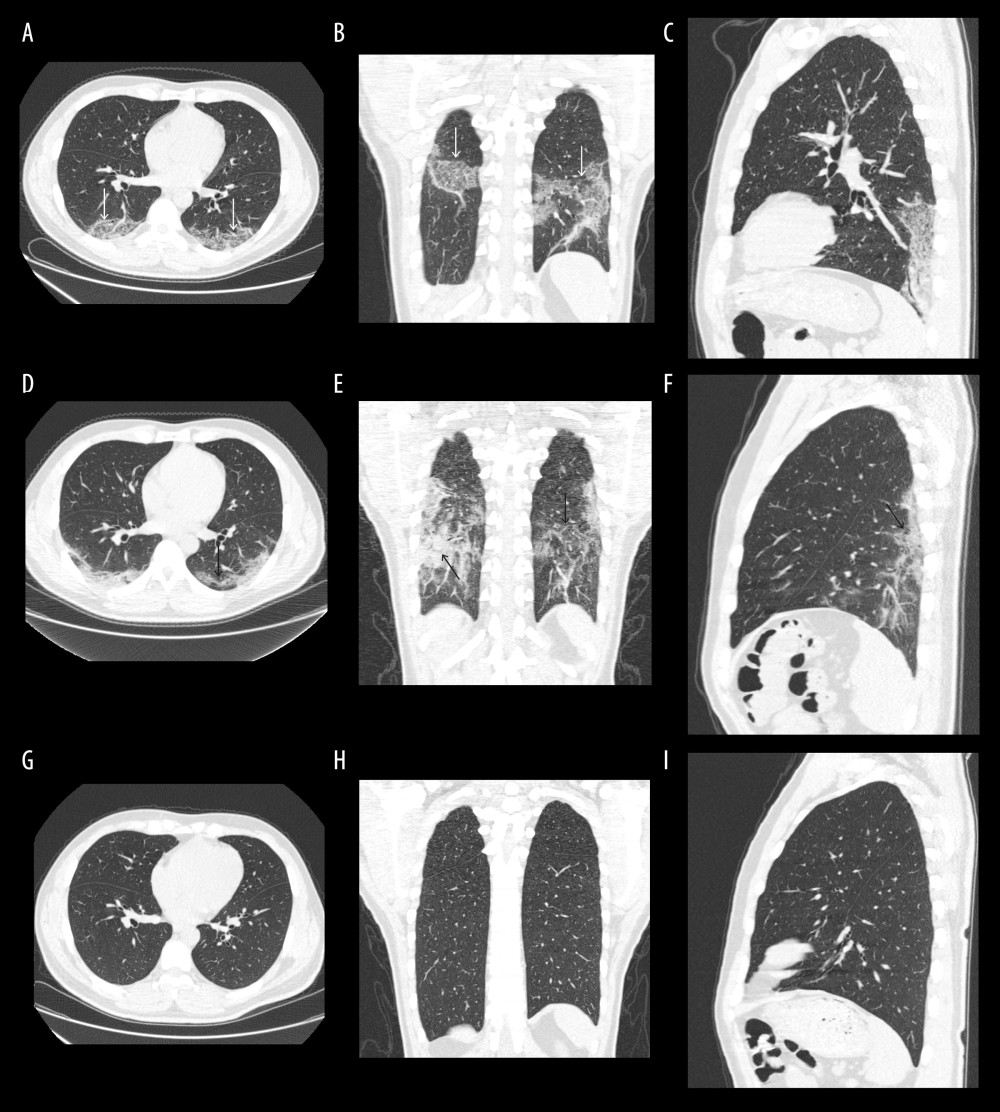 (A–I) A 39-year-old man with COVID-19. A–C=day 7, D–F=day 10, G–I=day 33, PIT25=3 days. (A–C) In the peak CT, chest images obtained on day 7 from symptoms onset. Chest axial image A, coronal reconstruction image B, and sagittal construction C show mixed lesions of GGO and reticulation in bilateral lower lobes, which are distributed in subpleural area (white arrow). (D–F) In the 25% improvement CT, chest images obtained on day 10 from symptoms onset. Chest axial image A, coronal reconstruction image B, and sagittal construction C show the lesions absorbed in the lower lobe, mainly in the left lung (short black arrow), and some of them transformed into consolidations (long black arrow). (G–I) In the last CT, chest images obtained on day 33 from symptoms onset. Chest images show the lesions in bilateral lung absorbed well.