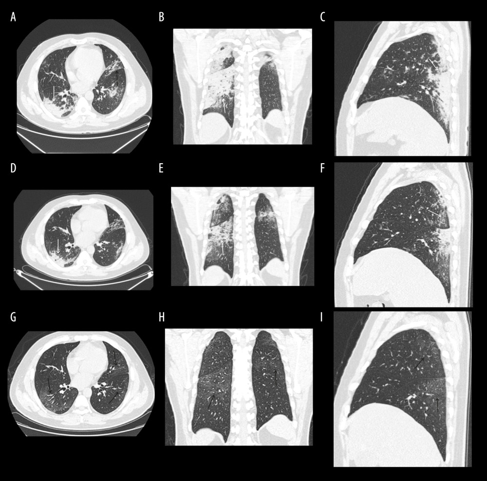 (A–I) A 44-year-old man with COVID-19. A–C=day 15, D–F=day 21, G–I=day 44, PIT25=6 days. (A–C) In the peak CT, chest images obtained on day 15 from symptoms onset. Chest axial image A, coronal reconstruction image B, and sagittal construction C show consolidation (short white arrow) and reticulation (short black arrow) in bilateral multiple lobes, which were distributed in center and subpleural areas, mainly in the subpleural areas. (D–F) In the 25% improvement CT, chest images obtained on day 21 from symptoms onset. Chest axial image A, coronal reconstruction image B, and sagittal construction C show the lesions absorbed in the bilateral lower lobe, mainly in the right lung (long white arrow). (G–I) In the last CT, chest images obtained on day 44 from symptoms onset. Chest images show the lesions in bilateral lung, with unclear absorption, leaving multiple thin GGOs (long black arrow).