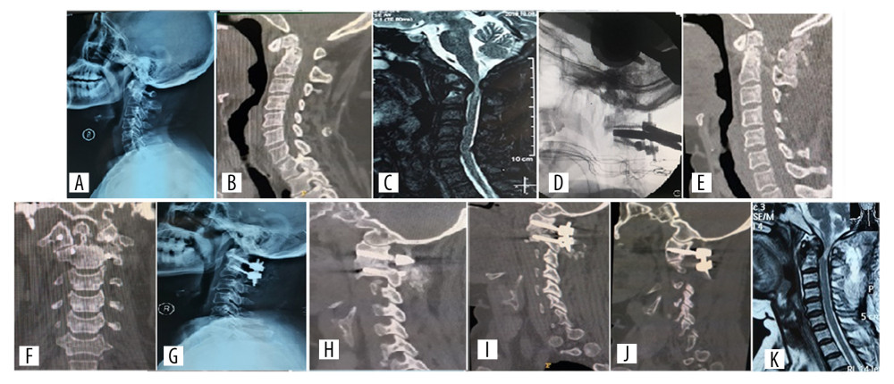 Preoperative, intra-operative, postoperative, 1 week and 9 weeks follow-up radiographs of a patient who had atlantoaxial dislocation caused by an old odontoid fracture treated with posterior atlantoaxial rod and screw fixation. (A–C) X-ray, CT, and MRI before the posterior atlantoaxial rod and screw fixation. (D) Intra-operative image of arthrolysis of atlantoaxial lateral mass. (E–G) CT and x-ray at 1 week after operation. (H) CT at 9 weeks after operation showed that strong fusion has been formed between the lateral mass joints. (I) One week after operation, CT showed the position of C1 pedicle screws on the left and right sides. (J, K) MRI at 1 week after operation showed that the compression of spinal cord has been relieved. CT – computed tomography; MRI – magnetic resonance imaging.