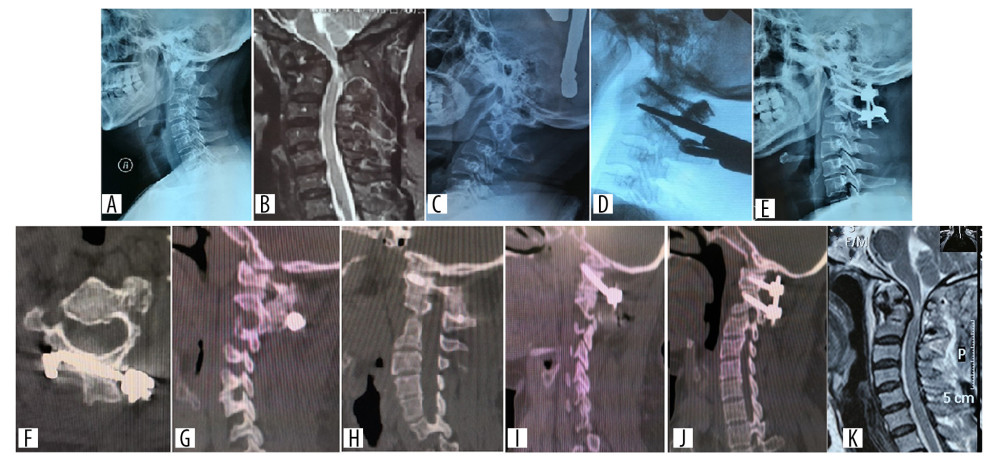 Preoperative, postoperative, 1- and 8-week follow-up radiographs of a patient with anatomical variation and atlantoaxial dislocation caused by an old odontoid fracture, who was treated with C2 bicortical lamina screw fixation. (A, B) X-ray and MRI before the bicortical lamina screw fixation. (C) X-ray imaging showing the reduction of dislocation after skull traction. (D) Intra-operative image of arthrolysis of atlantoaxial lateral mass. (E, F) Postoperative x-ray and CT imaging. (G) CT at 1 week after operation. (H) CT at 8 weeks after operation revealed strong fusion between the lateral mass joints. (I) One week after operation, CT showed the position of C1 pedicle screws on the left and right sides. (J, K) MRI at 1 week after operation showed that the compression of spinal cord has been relieved. CT – computed tomography; MRI – magnetic resonance imaging.