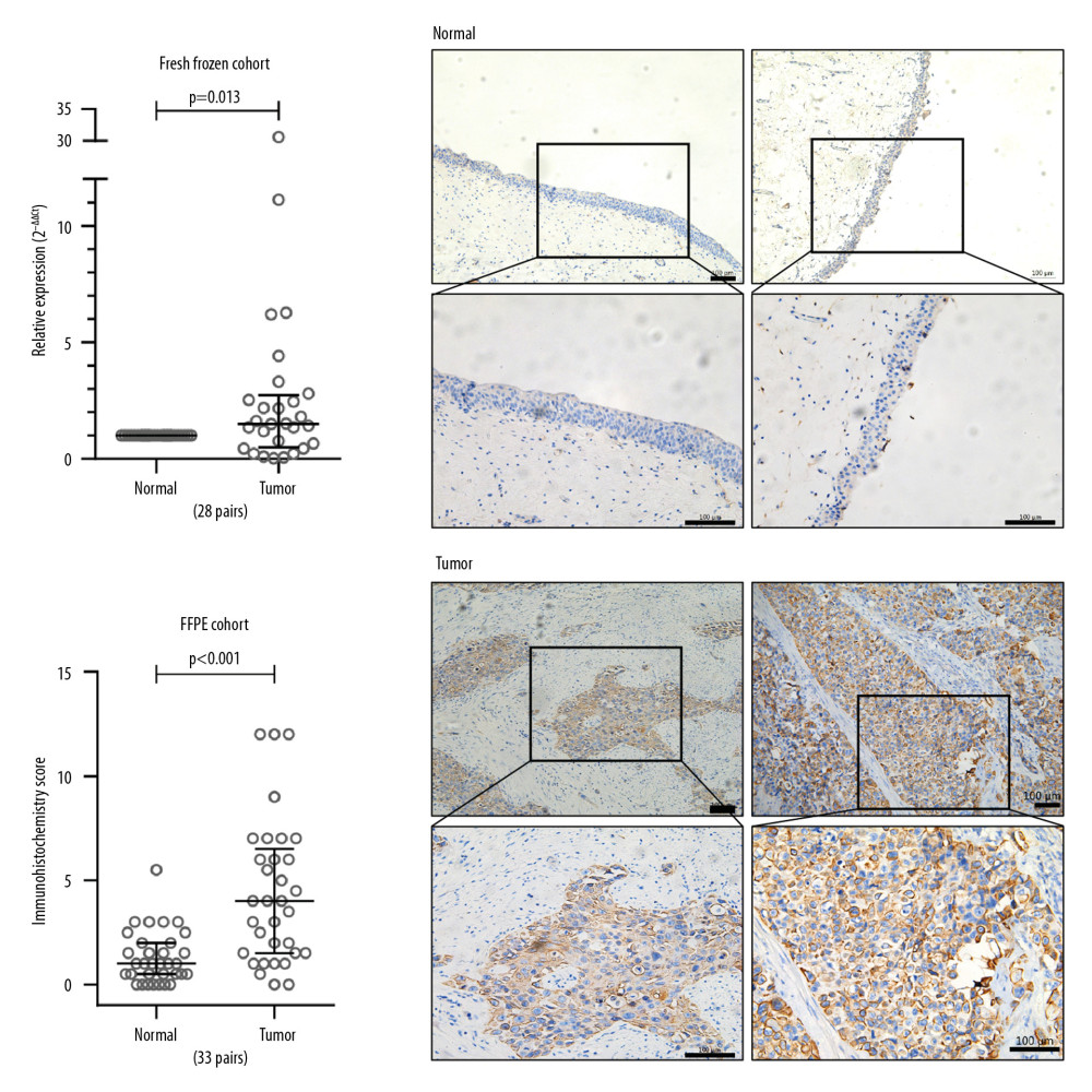 CEP78 overexpression confirmed in clinical samples collected by this study. (A) Comparison of the relative CEP78 expression in fresh-frozen tumor and adjacent normal tissues from 28 MIBC patients with Mann-Whitney test. (B) IHC straining scores of CEP78 in FFPE tumor and adjacent normal tissues from 33 MIBC patients compared with Mann-Whitney test or Wilcoxon signed rank test. The Mann-Whitney test p value is shown in the figure; while the Wilcoxon signed rank test p value also was <0.001. (C) Representative IHC staining images of the tumor and matched adjacent normal tissues. Images for one pair are placed in one row. All images were separately taken. Scale bar, 100 μm. Medians and interquartile ranges are shown for (A) and (B).