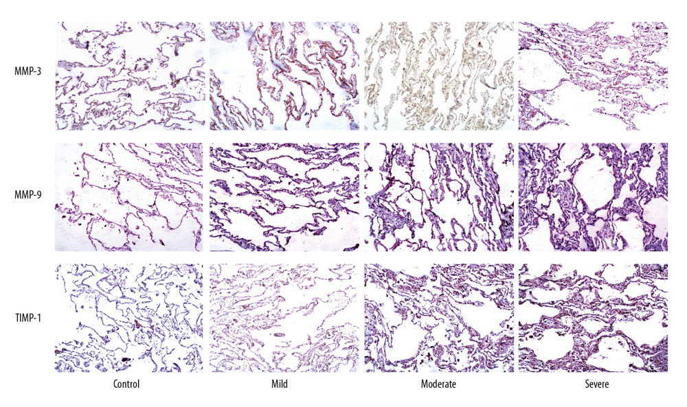 Immunohistochemical analysis of the expression of matrix metalloproteinase (MMP)-2, MMP-9, and tissue inhibitor of metalloproteinase (TIMP)-1 in alveolar septa (×100 magnification).