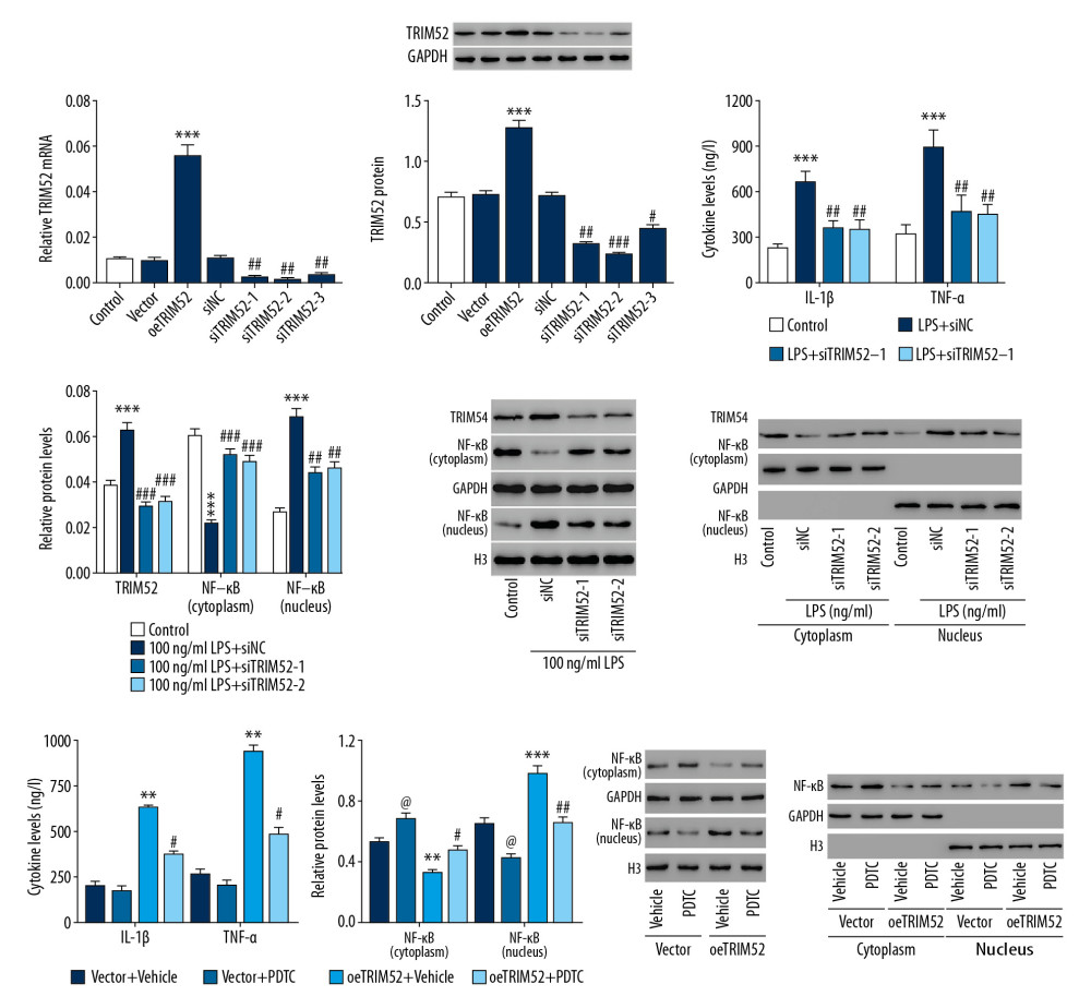 Knockdown of tripartite motif containing 52 (TRIM52) significantly inhibited lipopolysaccharide (LPS)-induced inflammatory response, likely through inhibition of NF-κB signaling activation. Construction of TRIM52 interference and overexpression lentivirus transfected rat microglial cells in vitro: Q-PCR (A) and western blot (B) were used to detect TRIM52 interference and overexpression efficiency *** P<0.001 vs. Vector; # P<0.05, ## P<0.01, ### P<0.001 vs. siNC. The TRIM52 gene interfered with lentivirus pre-transfected rat primary microglial cells and was treated with LPS at 100 ng/ml for 6 h. (C) ELISA was used to detect the levels of IL-1β and TNF-α in the cell supernatant. (D) Western blot was used to detect protein expressions of TRIM52 and NF-κB (cytoplasm and nuclear). *** P<0.001 vs. Control; ## P<0.01, ### P<0.001 vs. 100 ng/mL LPS+siNC. (E)4The efficient isolation of cytosolic and nuclear proteins was shown by western blot. TRIM52 gene-overexpressing lentivirus transfected rat primary microglial cells were treated with 10 μmol/L NF-κB inhibitor pyrrolidine dithiocarbamate (PDTC). (F) ELISA was used to detect the levels of IL-1β and TNF-α in the cell supernatant. (G) Western blot was used to detect NF-κB (cytoplasm and nuclear) protein expression. (H) The efficient isolation of cytosolic and nuclear proteins was shown by western blot. ** P<0.01, *** P<0.001 vs. Vector+Vehicle; # P<0.05, ## P<0.01 vs. oeTRIM52+Vehicle; @ P<0.05 vs. Vector+Vehicle.