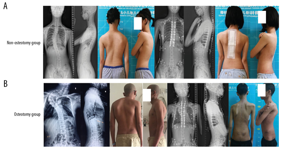 Two cases of the non-osteotomy group and osteotomy group. (A) A 14-year-old patient with scoliosis who was treated with a multilevel posterior correction without osteotomy (non-osteotomy group). (B) A 15-year-old patient with a severe and stiff scoliosis who was treated with a long posterior reconstruction from C7 to T12 with one-level grade 4 osteotomy at T4 (osteotomy group).