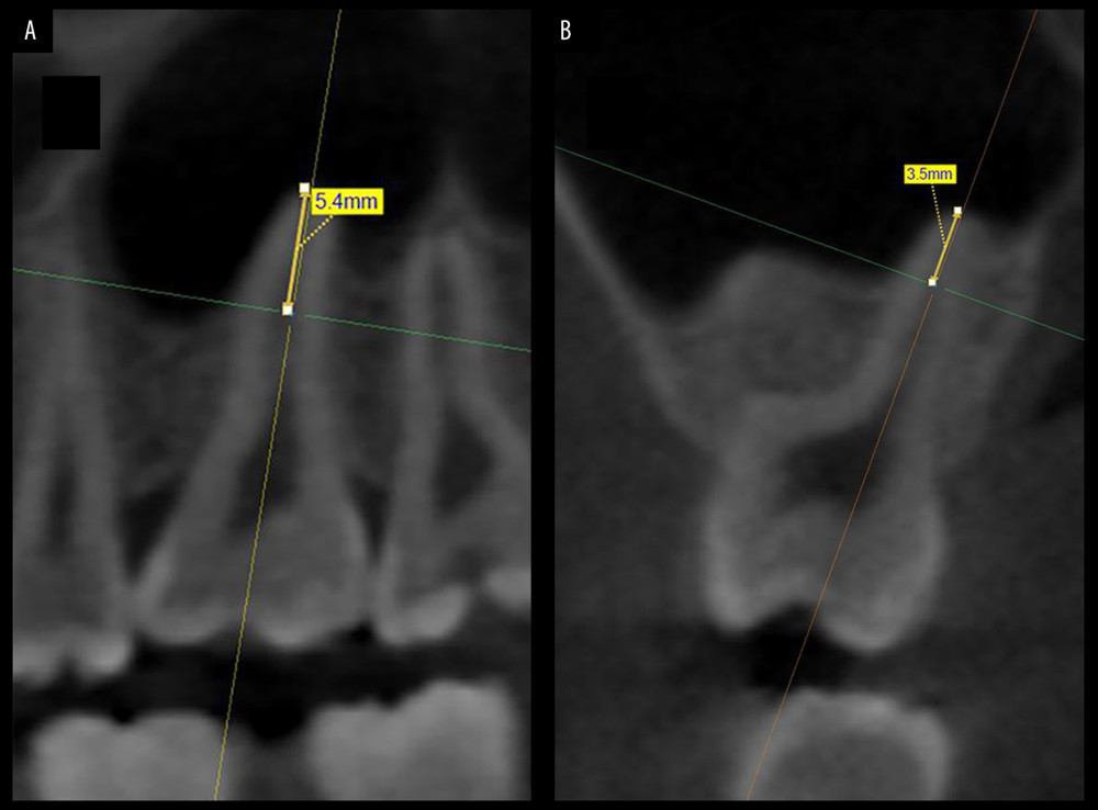 (A) Contact distance of the mesial root surface of 1M P with the MSW measured on the sagittal plane. (B) Contact distance of the buccal root surface of 1M P with the MSW measured on the coronal plane.
