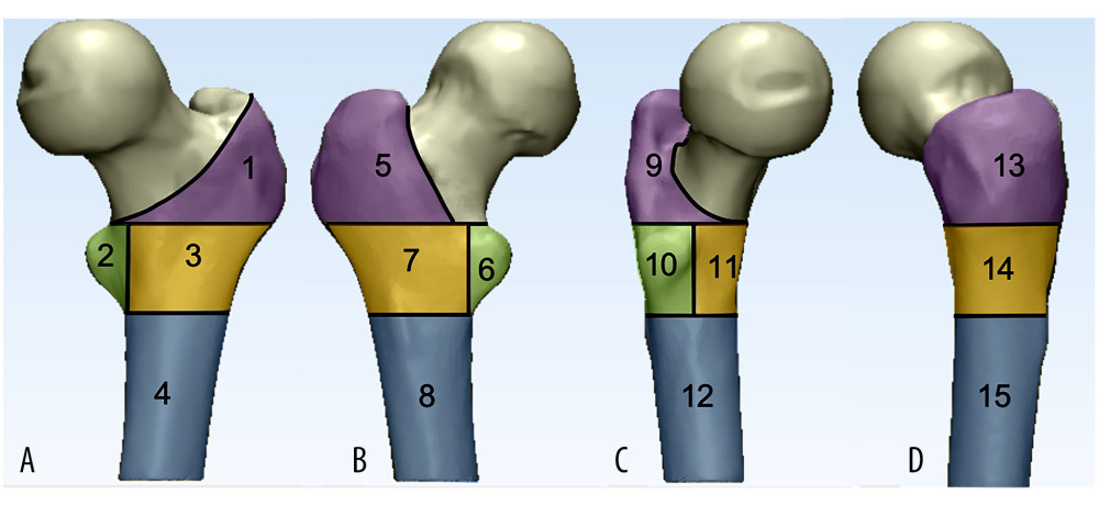Osseous zone models. (A) Anteroposterior, (B) posteroanterior, (C) medial, medial, (D) medial. Several separate lines divide the proximal femur into 4 osseous zones: greater trochanter area (purple area), lesser trochanter area (reseda area), lesser trochanter lateral area (yellow area), subtrochanteric area (wathet area).