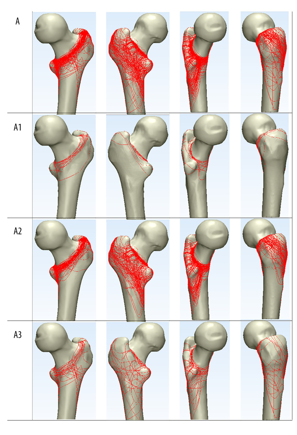 The 3D fracture mappings of intertrochanteric fractures in 4 views. The 115 elderly patients were classified based on the AO fracture classification system. “A” represented the pooled analysis of all fracture fragment, while expressions are for 3D fracture mappings of subtypes (including types A1, A2, and A3).