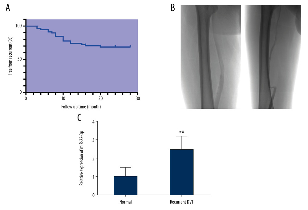 MiR-22-3p is associated with prognosis of deep vein thrombosis (DVT). (A) Kaplan-Meier curve revealed recurrence-free survival. (B) Representative digital subtraction angiography (DSA) images for patent vein (left) and recurrent venous thrombosis (VT, right). (C) Comparison of miR-22-3p expression in both normal and recurrent deep (D)VT patients. ** P<0.01.