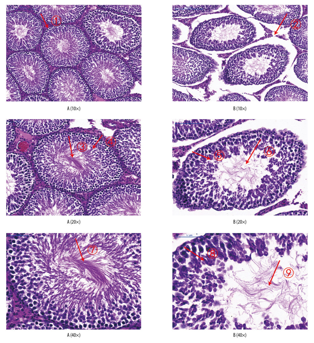 Analyses of testicular tissue in rats using H&E staining. The testicular tissue of rats was stained with hematoxylin & eosin (H&E) to observe pathologic changes in the testes under electron microscopy (n=6 animals per group). In Group A: (i) The convoluted tubules are closely arranged, and the boundary between the basal membrane and the stroma is clear and even (Arrow ➀); (ii) All levels of spermatogenic cells and spermatogenic cells are arranged in order (Arrow ➂➃➆). In Group B: (i) Spermatogenic tubules are damaged to different degrees, and the number and morphology of spermatogenic tubules are significantly changed (Arrow ➄➇); (ii) The convoluted tubules are sparsely arranged, interstitial edema is observed, and the epithelium of the tubules is separated from the stroma; the convoluted tubules have a cavity-like structure (Arrow ➁); (iii) The degeneration, nuclear shrinkage, and necrosis of spermatogenic cells and spermatogenic cells in the convoluted tubules is seen (Arrow ➅➈); (iv) All levels of spermatogenic cells have disappeared and proliferation of interstitial cells is seen (Arrow ➈).