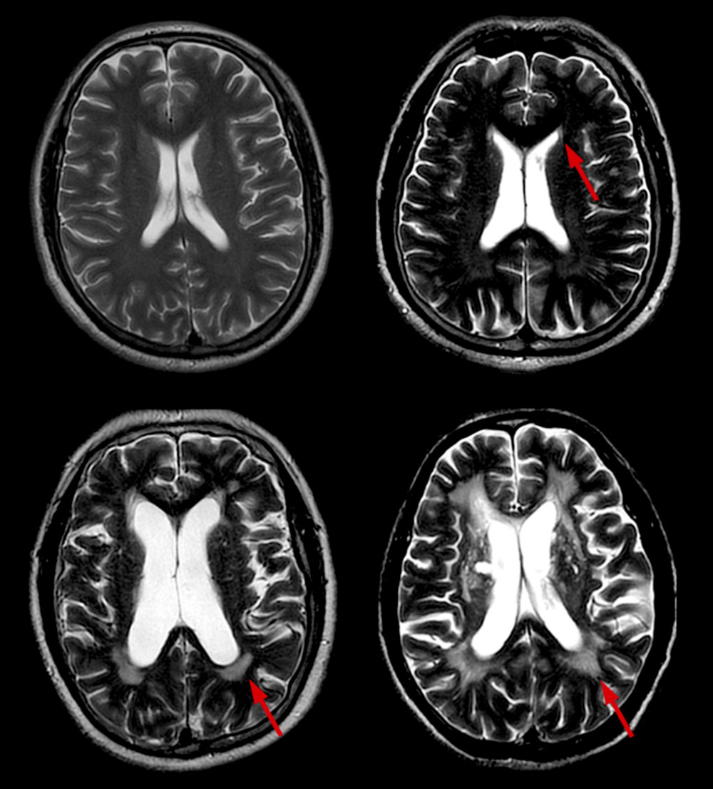 Different scores of PWMH. Scores of PWMH: (A) 0 score=absence; (B) 1=“caps” or pencil-thin lining; (C) 2=smooth “halo”; and (D) 3=irregular PWMH extending into the deep white matter. PWMH –periventricular white matter hyperintensities.