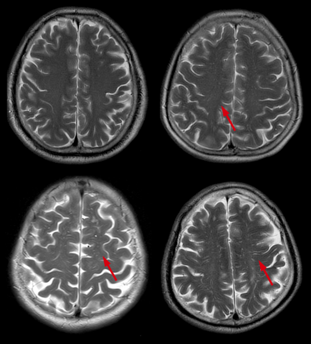 Different scores of CSO-EPVS. Scores of CSO-EPVS: (A) degree 1, <10 EPVS in the total white matter; (B) degree 2, >10 EPVS in the total white matter and <10 in the slice containing the greatest number of EPVS; (C) degree 3, 10–20 EPVS in the slice containing the greatest number of EPVS; and (D) degree 4, >20 EPVS in the slice containing the greatest number of EPVS. CSO – centrum semiovale; EPVS – enlarged perivascular space.
