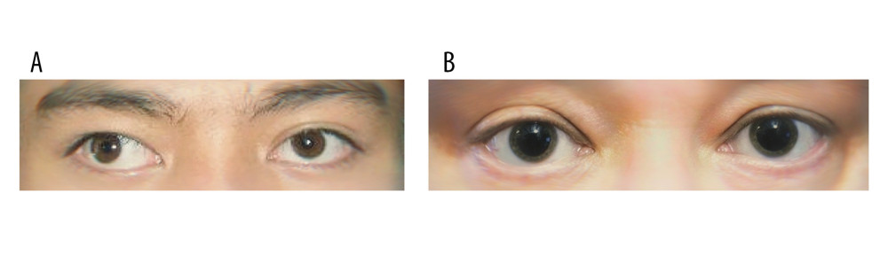 An example of SA patients and HC groups. (A) An adult strabismus with amblyopia patient. (B) An adult healthy control. SA – strabismus with amblyopia; HC – healthy control.