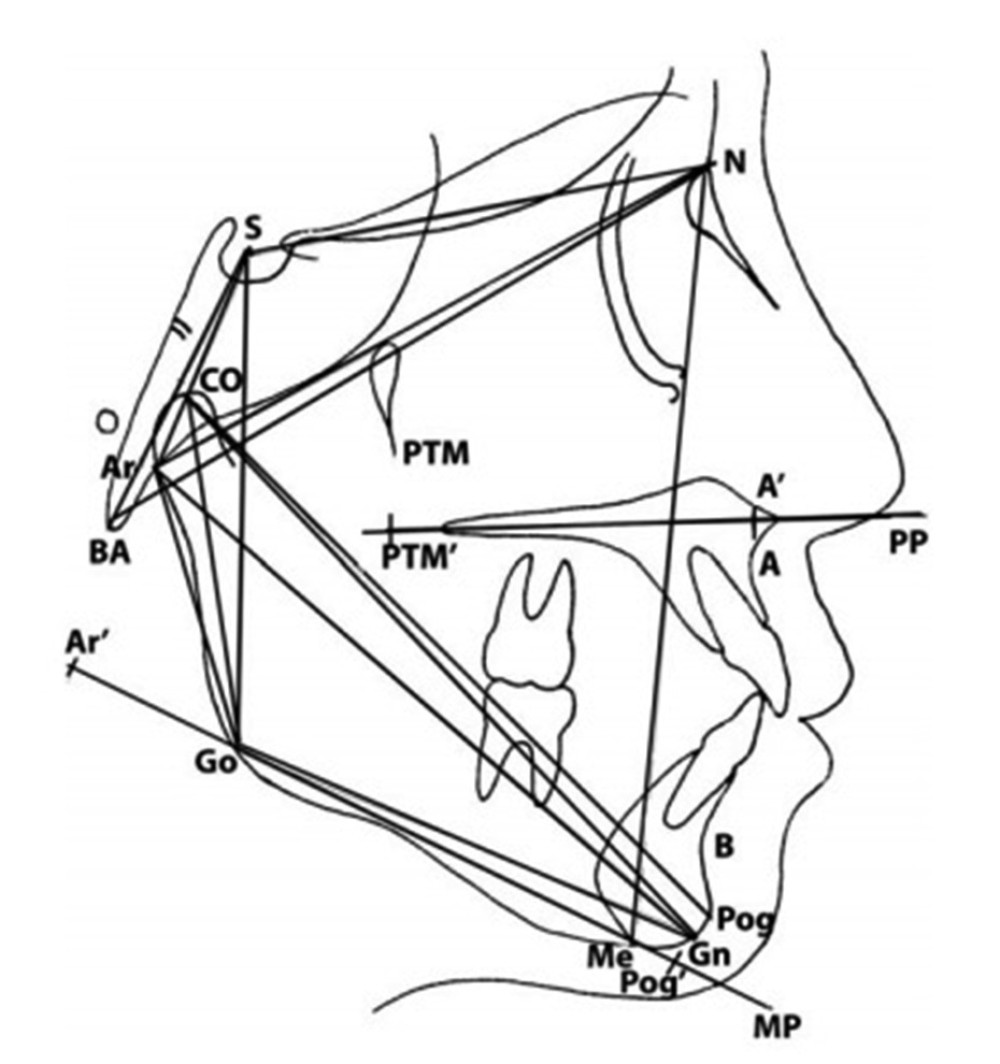 Lateral cephalometric measurements studied. Points: gonion (Go), gnathion (Gn), nasion (N), A perpendicular to palate plane (A).