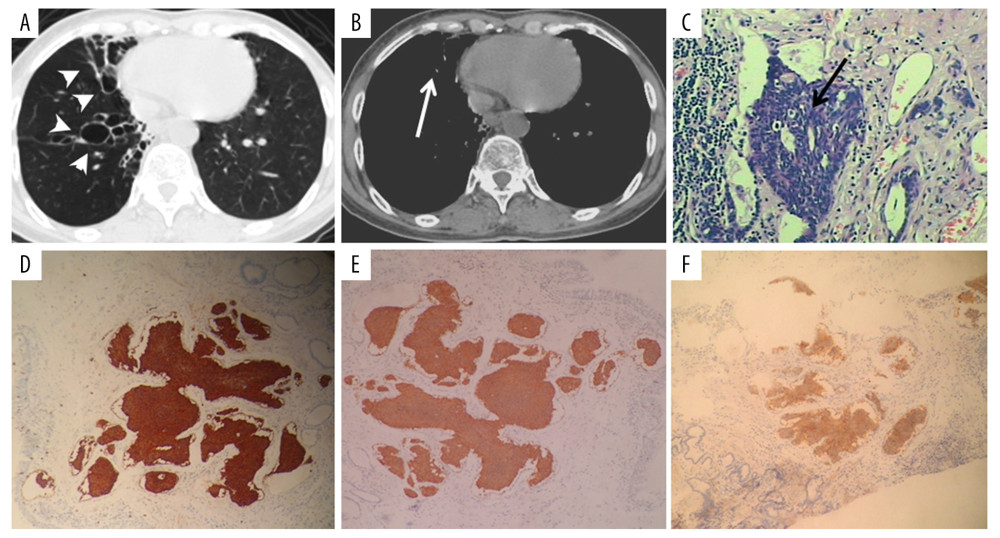 A 61-year-old woman with PCT and bronchiectasis. Dilated, beaded bronchi and cysts with defined borders can be observed in the lung window CT image (A, white arrowheads). Cord-like shadows can be observed in the mediastinal window (B, white arrows). PCT was evidenced by histopathological examination (C, black arrow). Tumorlets consisted of a comparatively uniform population of cells with oval or spindle nuclei. Mitoses were absent. Immunochemical staining revealed that the neuroendocrine markers CgA (D), Syn (E), CD56 (F), and NSE (G) were highly expressed in the tumorlets.