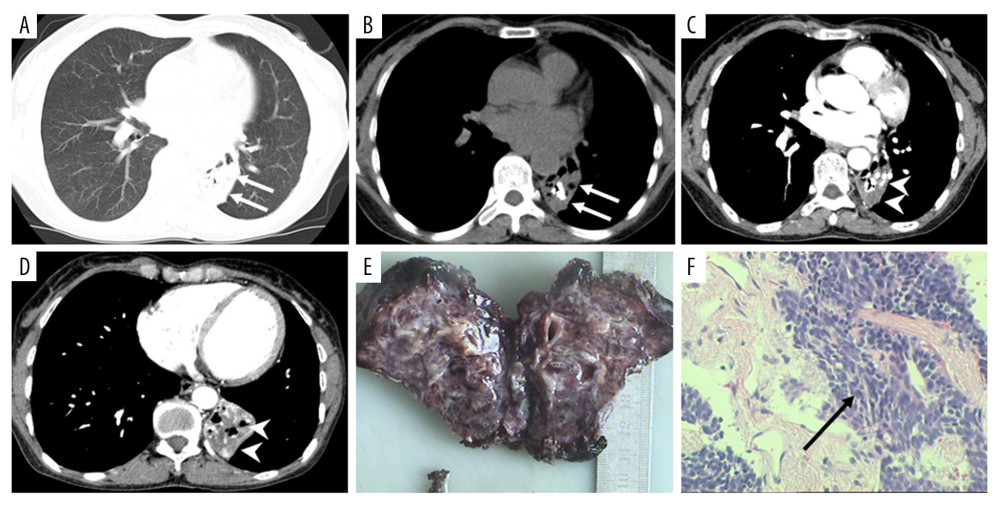 A 57-year-old woman with PCT and bronchiectasis and atelectasis. A patchy shadow was found in the left lower lobe on conventional CT image (long white arrows; A, lung window; B, mediastinal window) and contrast-enhanced CT images (white arrowheads; C, D). Obviously dilated and beaded bronchi were observed in the lung section (E). PCT was shown by histopathological examination (F, black arrow). Tumorlets consisted of a comparatively uniform population of cells with oval or spindle nuclei, without mitoses.