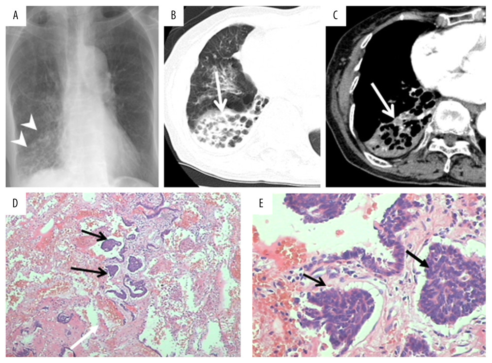 A 68-year-old woman with PCT and pulmonary tuberculosis. A patchy shadow was found in the middle right lobe on chest radiographs (A, white arrowheads) and CT images (long white arrows; B, lung window; C, mediastinal window). A 6.0×4.0×2.0 cm lung section was obtained and a sallow nodule was found. Several tuberculoid nodules and carcinoid tumorlets (D, E, black arrows) were observed in histopathological examination. Tumorlets consisted of a comparatively uniform population of cells with oval or spindle nuclei.