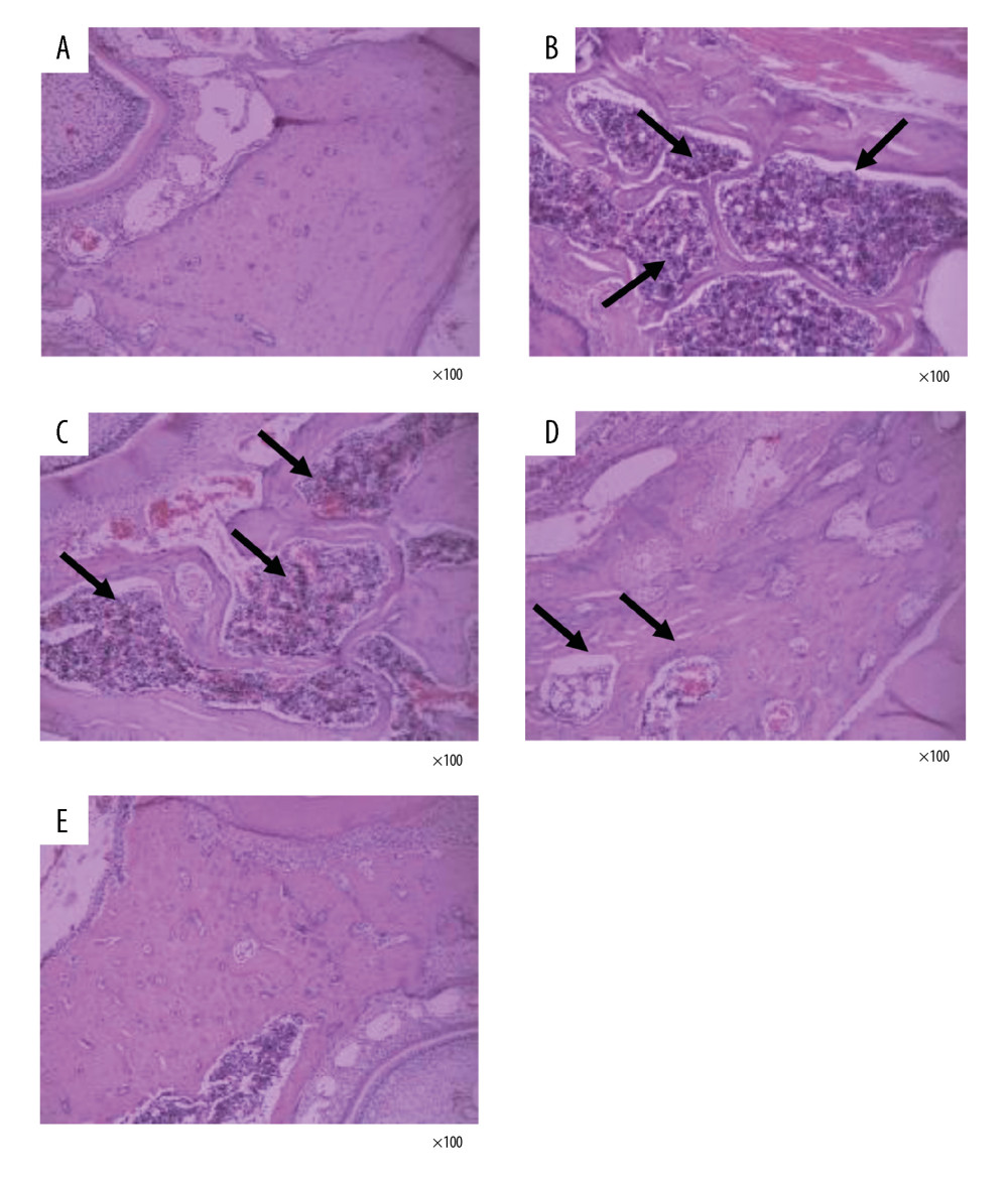 Drynaria total flavonoids (DTF) improved the histopathological changes in rat mandibles after ovary removal. The histopathological changes of the mandible of each group were investigated by H&E staining (×100). (A) Sham group, (B) ovariectomy control (OVX) group, (C) low-dose group, (D) middle-dose group, and (E) high-dose group. The arrows indicate the osteoporotic lesions in the mandible, including abnormal bone resorption, reduced number of trabeculae, and bite-like changes.