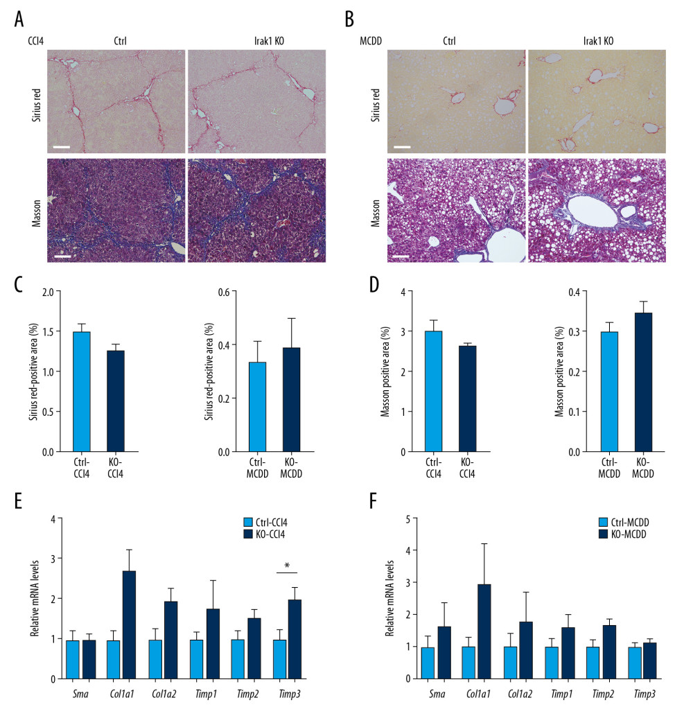 Effects of Irak1 KO on collagen deposition in mouse models of NASH. (A, B) Representative Sirius red (upper part) and Masson (bottom part) stained liver sections of Irak1 KO and control mice following (A) CCl4 treatment for 8 weeks (n=5–6) or (B) MCDD feeding for 6 weeks (n=3–4). Scale bars, 100 μm. (C, D) Digital quantification of (C) Sirius red-positive and (D) Masson stain-positive areas of livers of Irak1 KO and control mice following CCl4 treatment for 8 weeks (n=5–6) or MCDD feeding for 6 weeks (n=3–4). (E, F) Hepatic levels of Sma, Col1a1, Col1a2, Timp1, Timp2, and Timp3 mRNAs in Irak1 KO and control mice following (E) CCl4 treatment for 8 weeks (n=5–6) or (F) MCDD feeding for 6 weeks (n=5). Data represent mean±SEM. * p<0.05 by t test.