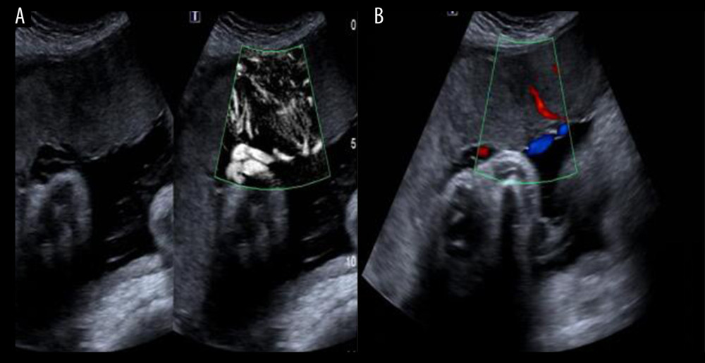Vascular display of the central part of the placenta by (A) SMI and (B) CDFI of women after 30 weeks of gestation.