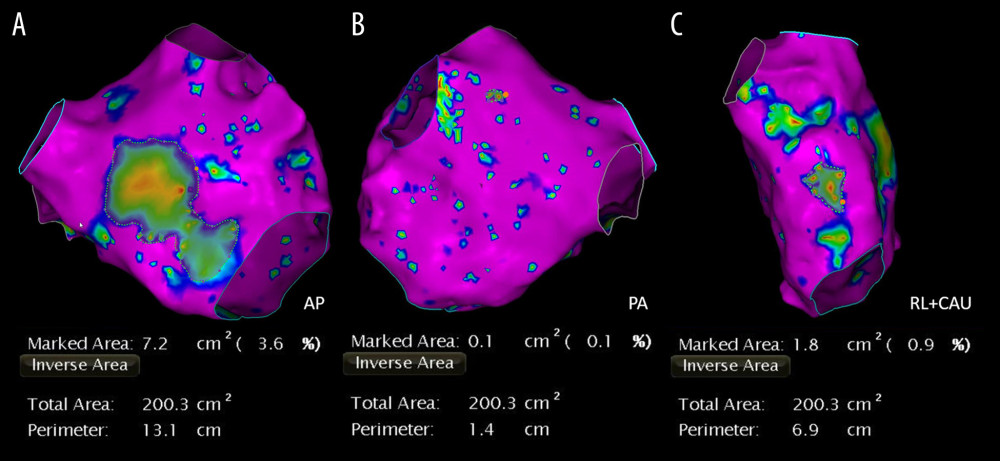 Low-voltage zone measurement using bipolar voltage mapping. Purple areas indicate normal LA substrate and colorful areas indicate low voltage zone. Total area refers to the entire left atrial area except for the pulmonary veins and mitral valve. Areas are measured in the AP (A), PA (B), and RL+CAU (C) positions.