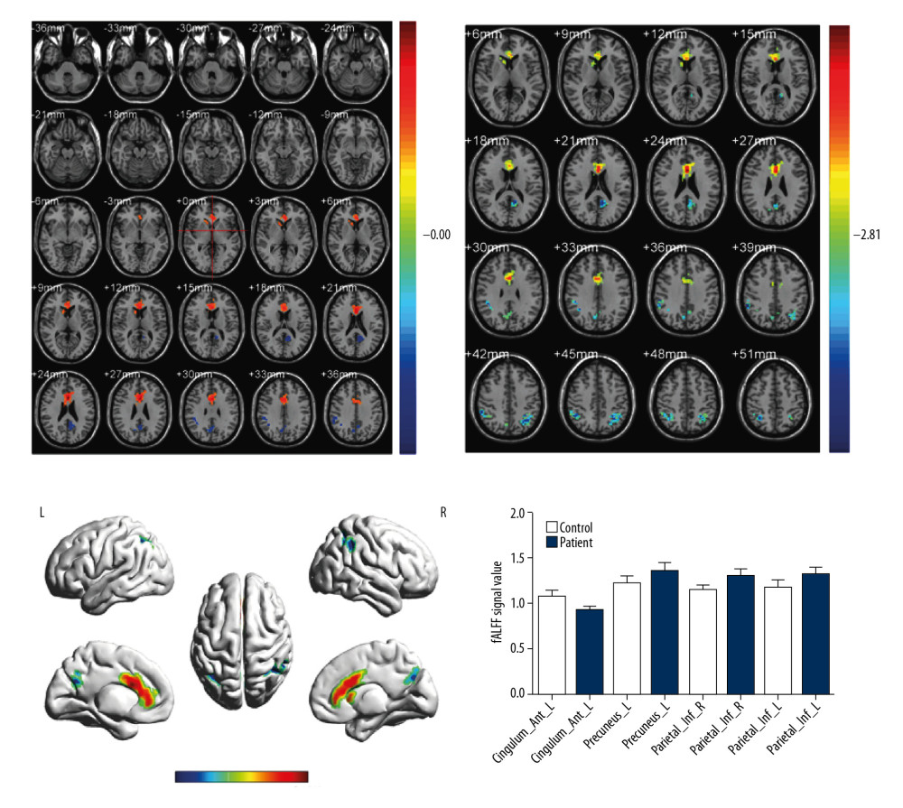 Spontaneous cerebral activity in MB patients and HCs. Significant brain activity differences were observed in the left anterior cingulate and paracingulate gyri, left precuneus, right inferior parietal, but supramarginal and angular gyri and left inferior parietal, but supramarginal and angular gyri. The red or yellow denotes increased fAlFF values, and the blue areas indicate decreased fAlFF values, respectively (P,0.01 for multiple comparisons using Gaussian random field theory [z.2.3, P,0.01, cluster. 40 voxels, Alphasim corrected]). MB – monocular blindness; HCs – healthy controls; fALFF – fractional amplitude of low-frequency fluctuation; L – left; R – right.
