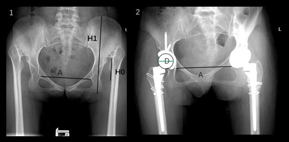 Measurement of dislocation height on anteroposterior radiographs. A: Inter-teardrop line. H0: Dislocation height, defined as the vertical distance from the junction of the femoral head and neck to the inter-teardrop line. H1: Pelvic width, defined as the vertical distance between the horizontal line of the highest point of the pelvis and the horizontal line of the lowest point of the pelvis. D: Femoral head diameter (28 mm), as a calibration standard.