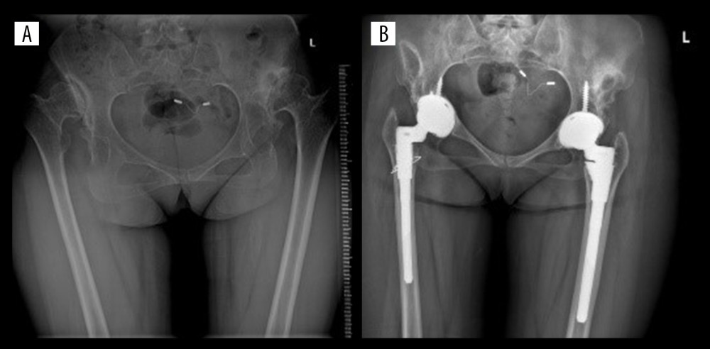 Total hip arthroplasty with S-ROM prosthesis in patients with bilateral Crowe Type IV DDH. (A) Preoperative radiograph: secondary acetabulum formation in bilateral hips; (B) Postoperative radiograph: S-ROM prosthesis with cone-shaped sleeve (right) and S-ROM prosthesis with triangle-shaped sleeve (left).