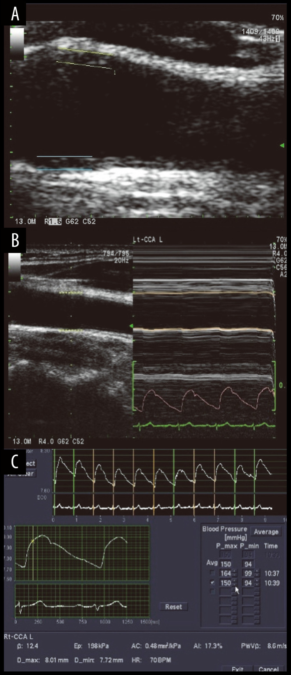 Detection interface (A), endocardial interface (B), and ET elastic curve (C).