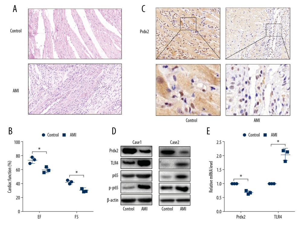 Expression of Prdx2 in AMI rats was lower than that in the control group. (A) HE staining of rat myocardial tissue (magnification: 200×) (n=3); (B) EF and FS results of cardiac function (n=3); (C) Expression of Prdx2 in rat myocardial tissue (n=3) (magnification: 200×); (D) Western blot results of Prdx2, TLR4, p65, and p-p65 in rat myocardial tissue (n=3); (E) mRNA expression of Prdx2 and TLR4 in rat myocardial tissue (n=3). (“*” means the difference between the 2 groups was statistically significant and P<0.05).