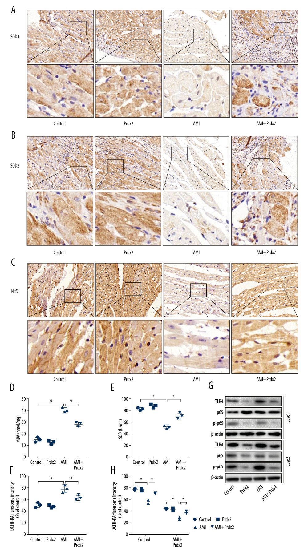Prdx2 recombinant protein reduces myocardial oxidative stress in AMI rats. (A–C) IHC staining results of SOD1/2 and Nrf2 in rat myocardial tissue (n=3) (magnification: 200×); (D, E) ELISA results of MDA and SOD (n=3); (F) ROS level of rat myocardial tissue (n=3); (G) Western blot results of SOD1 and SOD2 (n=3); (H) EF and FS results of cardiac function (n=3). (“*” means the difference between the 2 groups was statistically significant and P<0.05).
