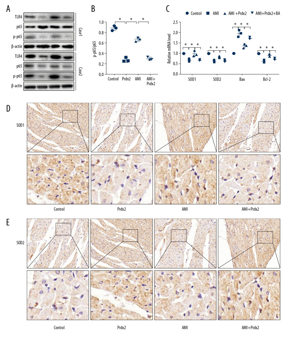 Prdx2 inhibits TLR4/NF-κB signaling pathway in rat cardiomyocytes. (A) Western blot results of TLR4, p65, and p-p65 (n=3); (B) Ratio of expression of p-p65 and p65 (n=3); (C) mRNA expression of SOD1, SOD2, Bax, and Bcl-2 (n=3); (D, E) IHC staining results of SOD1 and caspase8 in rat myocardial tissue (n=3) (magnification: 200×). (“*” means the difference between the 2 groups was statistically significant and P<0.05).