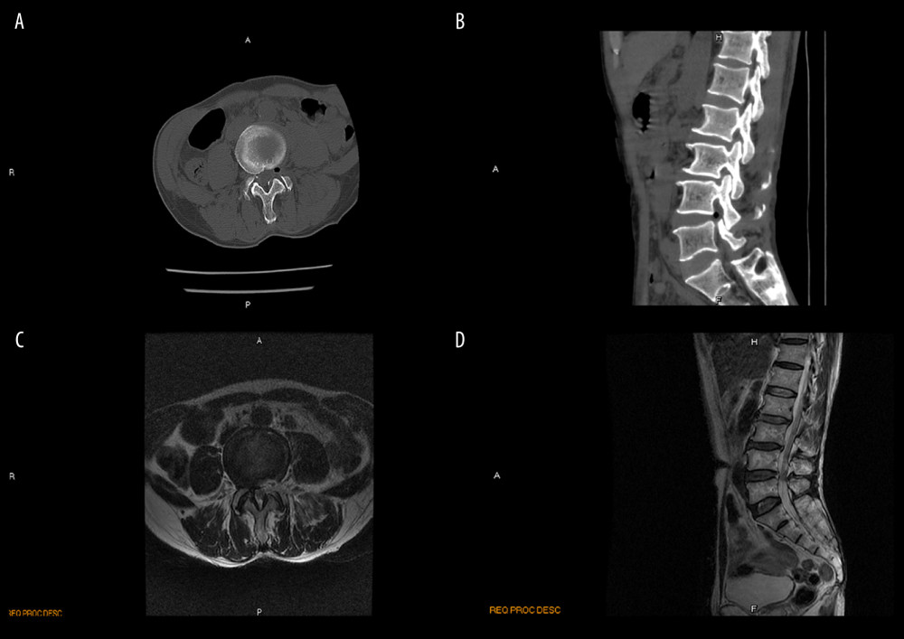 Postoperative computed tomography (CT) scan and magnetic resonance image (MRI) taken during percutaneous transforaminal endoscopic decompression in a 65-year-old man with degenerative lumbar spinal stenosis. Compression is absent (red arrowhead) on the postoperative CT scans (A, B) and MRIs (C, D).