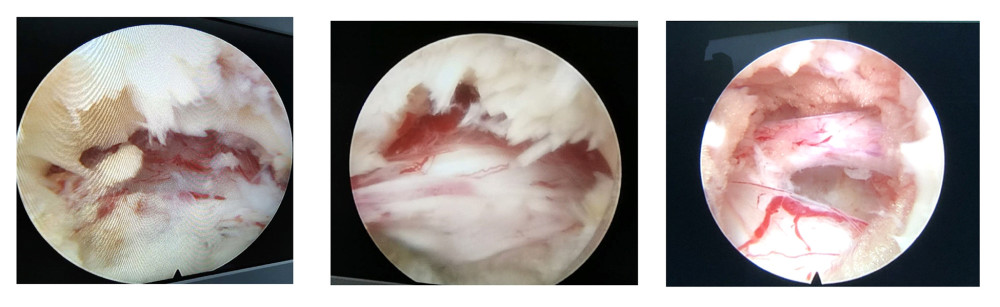 Images of the nerve root during percutaneous transforaminal endoscopic decompression in a 65-year-old man. The compression of the nerve root was relieved by removing the hypertrophied ligamentum flavum.