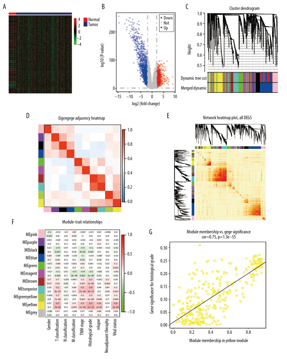 Bioinformatic analysis of ccRCC and normal kidney samples in the TCGA database.(A, B) The heatmap and volcano plot of the DEGs between 539 ccRCC cases and 72 normal samples. (C) Cluster dendrogram of DEGs and module screening based on gene expression profiles of 539 ccRCC samples. (D, E) Heatmap of the correlation coefficient expressed between modules. (F) Relationships between consensus module eigengenes and various clinical traits. (G) Analogous scatter plots for the yellow module. ccRCC – clear cell renal cell carcinoma; TCGA – The Cancer Genome Atlas; DEGs – differently expressed genes.