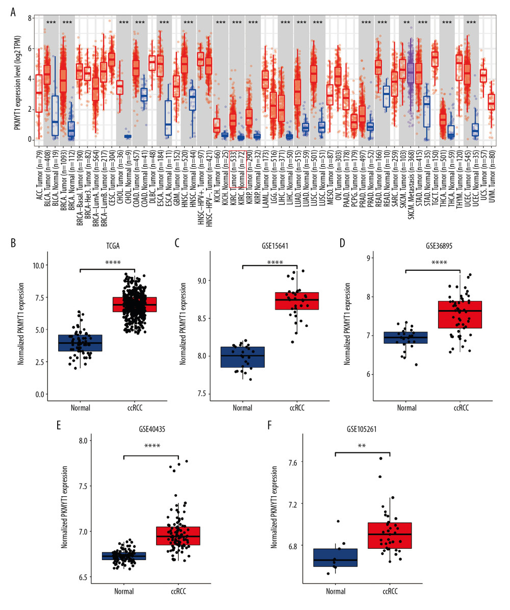 PKMYT1 is prominently overexpressed in ccRCC. (A) PKMYT1 mRNA expression in multiple neoplasms and adjacent normal samples from the TIMER database. PKMYT1 mRNA level in ccRCC and normal kidney tissues from (B) the TCGA database, (C) GSE15641, (D) GSE36895, (E) GSE40435, and (F) GSE105261. ccRCC – clear cell renal cell carcinoma; TIMER – Tumor Immune Estimation Resource.