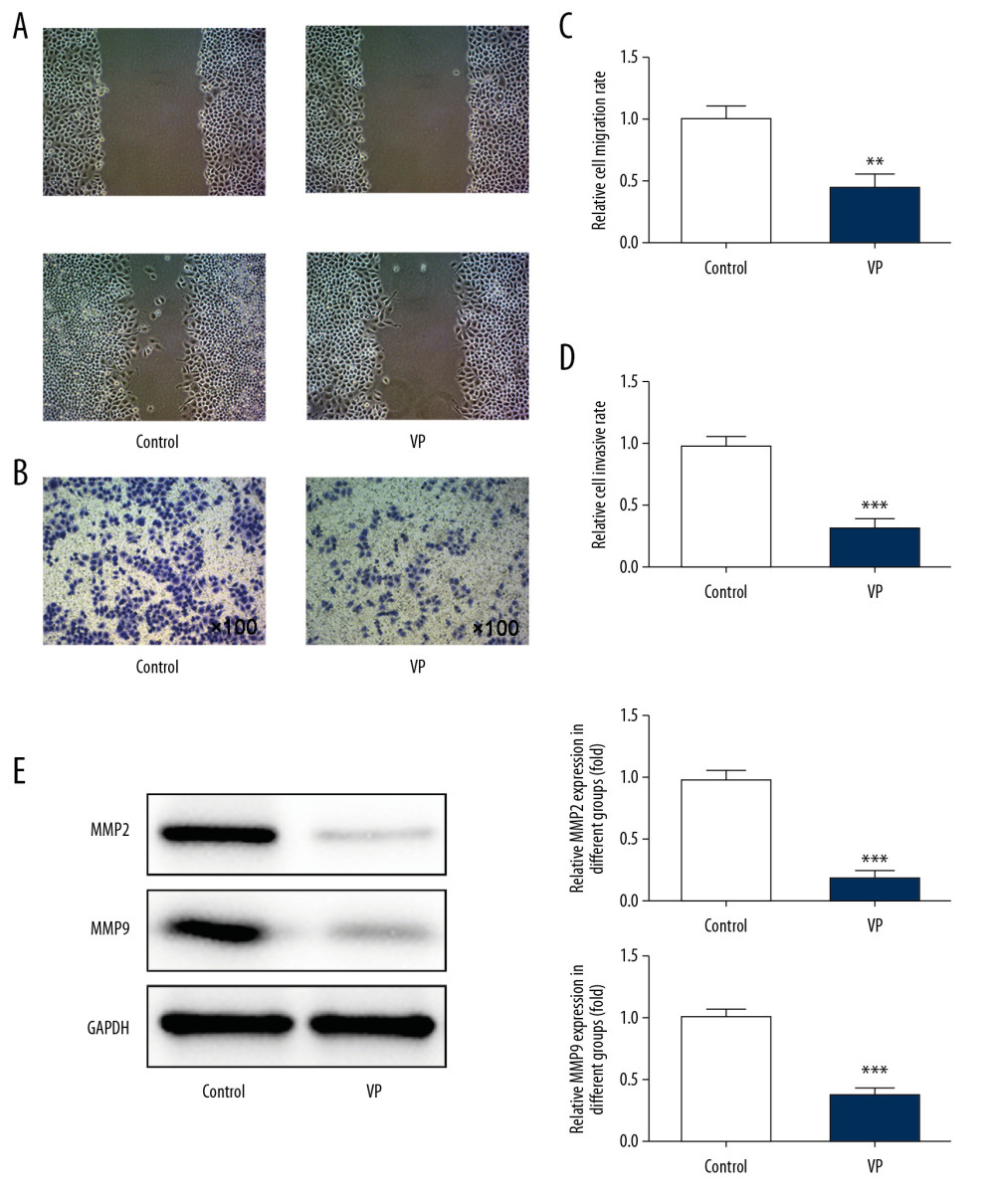 Verteporfin (VP) inhibited the migration and invasion of cervical cancer cells. (A, C) The migration of HeLa cells treated with 5 μM VP was analyzed by wound healing assay. ** P<0.01 vs. Control group. (B, D) The migration of HeLa cells treated with 5 μM VP was analyzed by transwell assay. *** P<0.001 vs. Control group. (E) The expression of MMP2 and MMP9 in HeLa cells treated with 5 μM VP was determined by western blot analysis. *** P<0.001 vs. Control group.