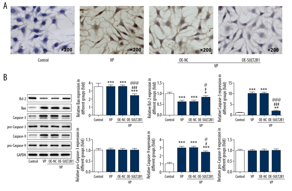 SULT2B1 overexpression weakened the promotion effect of verteporfin (VP) on the apoptosis of cervical cancer cells. (A) The apoptosis of HeLa cells after transfection and VP treatment was detected by TUNEL assay. (B) The expression of Bcl-2, Bax, caspase-3, pro-caspase-3, caspase-9 and pro-caspase-9 in HeLa cells after transfection and VP treatment was determined by western blot analysis. * P<0.05, ** P<0.01 and *** P<0.001 vs. Control group. # P<0.05 and ### P<0.001 vs. VP group. @ P<0.05 and @@@ P<0.001 vs. OE-NC group.