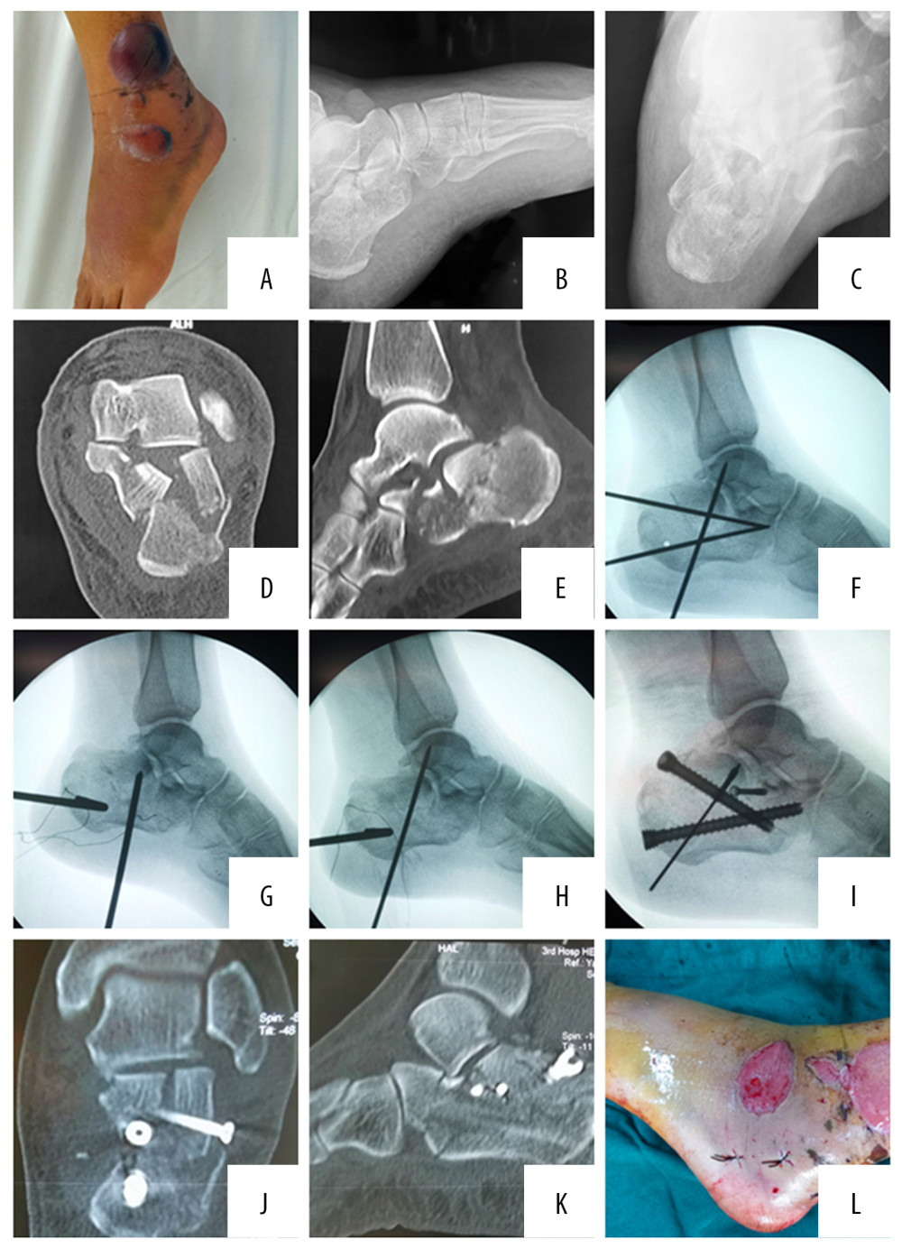 A 53-year-old woman had a left lateral calcaneal fracture caused by a fall from height. Preoperative skin condition of the patient (A). Preoperative X-ray: lateral view (B) and axial view (C) showed intra-articular calcaneal fractures. A preoperative CT scan (D, E) showed a Sanders Type-III. 3.5-mm Steinmann pins as the traction pins were inserted at the calcaneal (F); and the top of the 3.5 mm Kirchner wire was placed under the collapsed articular bone to reduce the collapsed articular surface (G); then the 2.0-mm Kirchner wire was used for temporary fixation (H); and the hollow screw was inserted to achieve the axial support fixation of the calcaneus (I). Postoperative CT scan (J, K) showed smooth articular surface and restoration of the width of calcaneus, and postoperative minimally invasive skin incision (L).
