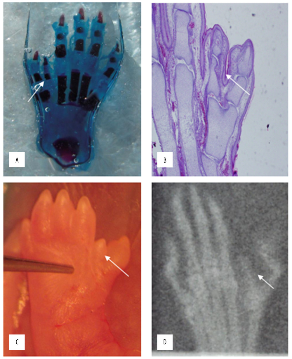HE staining (A) bone cartilage staining (B) the picture of the deformed hand (C) X-ray (D). All those images of the thumb polydactyly rats were used to observe limb morphology and newborn redundant bone.