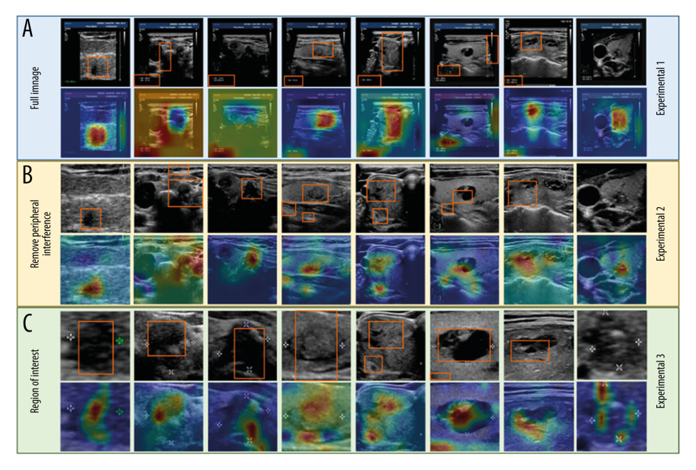 Corresponding visualization results are shown for experiments 1–3. The areas of the orange frames represent the visualization results on the datasets. Each column shows the same ultrasound image with different degrees of segmentation. (A) Experiment 1: The model was trained and tested using full images. (B) Experiment 2: The model was trained and tested using images after the removal of peripheral interference. (C) Experiment 3: The model was trained and tested using the region of interest (ROI).