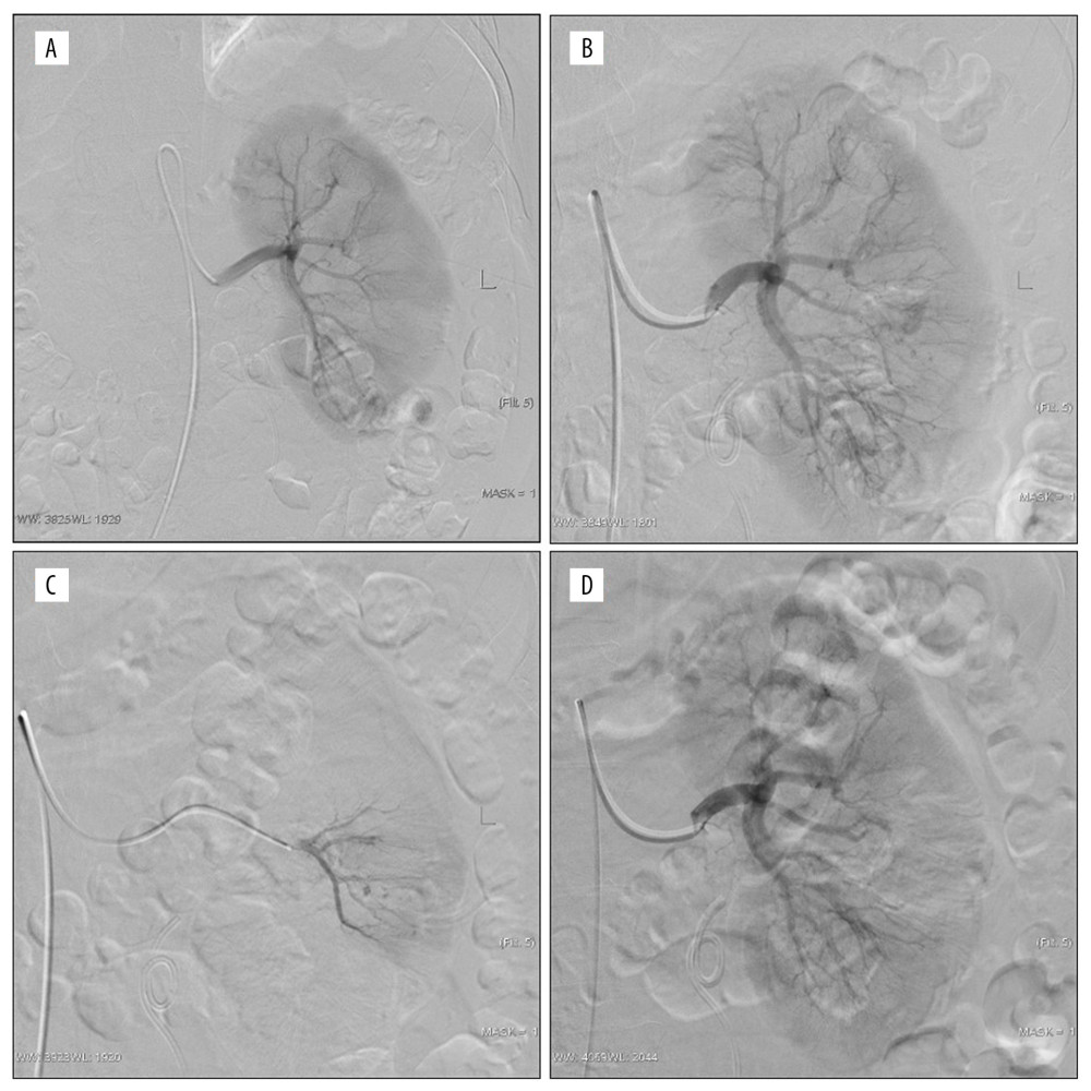 Active bleeding areas and persistent hematuria after the left percutaneous nephrolithotomy (PCNL). (A) No definite abnormality; (B, C) multiple spikes of contrast media in puncture tract were observed by magnification angiography and superselective anterior inferior segment angiography; (D) postembolized by 300 μm polyvinyl alcohol, the embolization volume was about 15%.