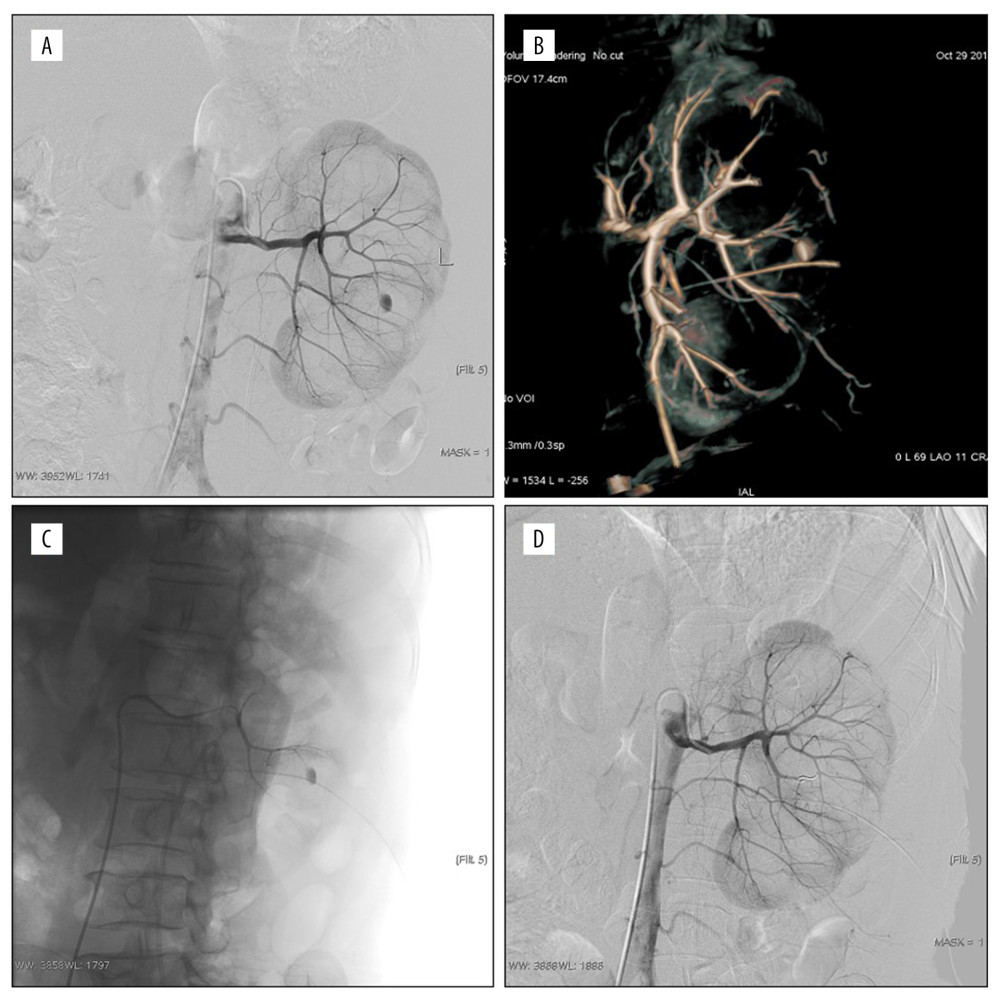 Persistent hematuria after the left percutaneous nephrolithotomy (PCNL); (A, B) Pseudoaneurysm of posterior segment artery was formed, digital subtraction angiography and volume rendering showed the origin of the parent artery; (C) Superselective to parent aneurysm angiography; (D) post-embolized by 100 μm polyvinyl alcohol and the coil. The pseudoaneurysm disappeared and the embolization volume was about 5%.
