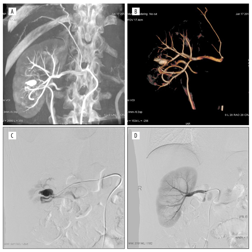 Persistent hematuria after the right percutaneous nephrolithotomy (PCNL). (A, B) Anterior inferior artery pseudoaneurysm (PA) and renal arteriovenous fistula (RAVF). Digital subtraction angiography and volume rendering showed blood supply artery and drainage vein; (C) The flow velocity of AVF was judged by superselective arteriography; (D) postembolized by the coil and 300 μm polyvinyl alcohol. The PA and RAVF disappeared and the embolization volume was about 15%.