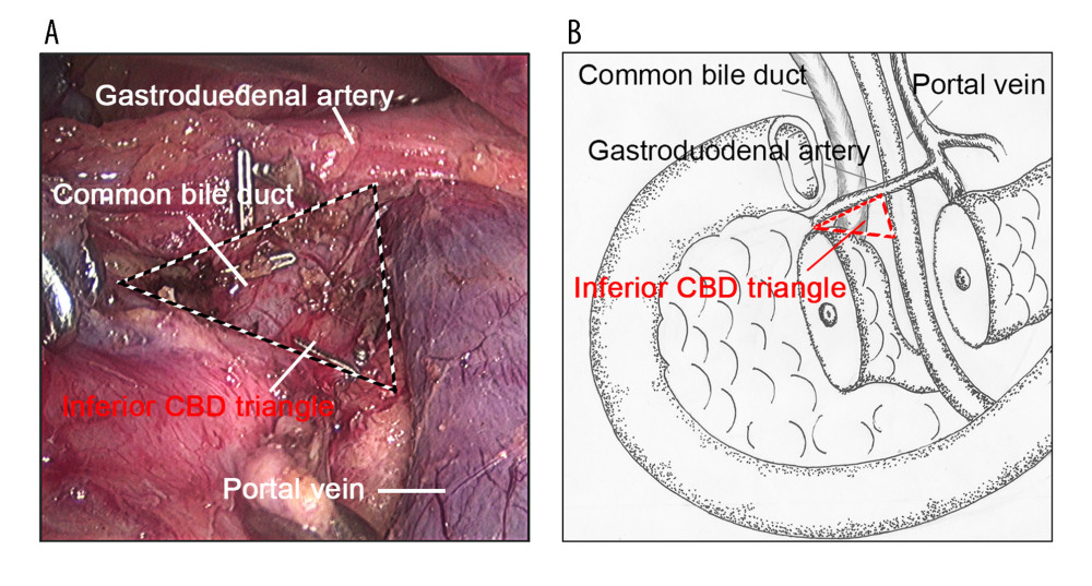 The inferior CBD triangle. (A) Intraoperative images of the inferior CBD triangle. The inferior CBD triangle is formed by the GDA, the portal vein, and the superior edge of the pancreas. (B) Pattern diagrams of the inferior CBD triangle. CBD – common bile duct; GDA – gastroduodenal artery.