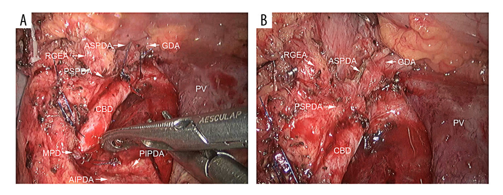 Intraoperative photographs after the pancreatic head was removed using the LDPPHRt procedure. (A) Images showing the superior and inferior artery arcades and the common bile duct after pancreatic-head resection. (B) The ASPDA was ligated and cut during the procedure, while the PSPDA was preserved. ASPDA – anterior superior pancreaticoduodenal arteries; PSPDA – posterior superior pancreaticoduodenal arteries; RGEA – right gastroepiploic artery; PV – portal vein; MPD – main pancreatic duct; AIPDA – anterior inferior pancreaticoduodenal arteries; PIPDA – posterior inferior pancreaticoduodenal arteries.