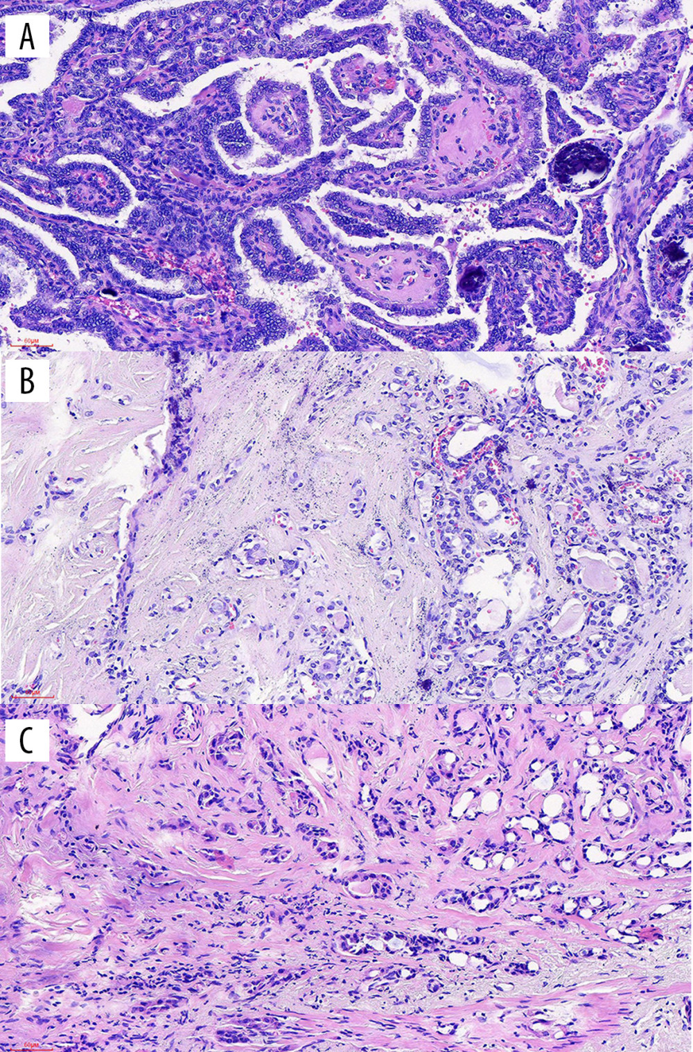 (A–C) Photomicrographs of the histopathology of a well-circumscribed papillary thyroid microcarcinoma (PTMC) measuring less than 10 mm in the thyroid isthmus showing cuboidal and columnar cells, some with nuclear inclusions and nuclear grooves, and few mitoses. Hematoxylin and eosin (H&E) ×200.