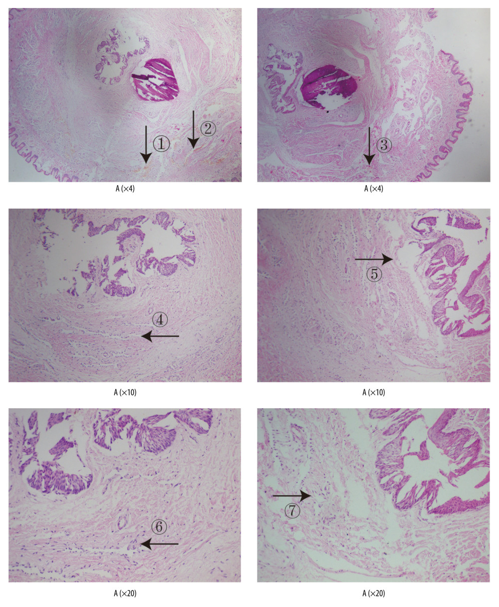 Analyses of penis tissue in rats using hematoxylin and eosin (HE) staining. The penis tissue of rats was stained with HE to observe pathologic changes in the penis under electron microscopy (n=6 animals per group). In group A: (i) the blood sinuses are abundant and neatly arranged (arrows ➀ ➁); (ii) tissue gap is small (arrows ➃); (iii) nucleus is abundant (arrows ➅). In group B: (i) the blood sinuses are significantly reduced (arrows ➂); (ii) smooth muscle fibers are disorderly arranged and tissue gaps increase (arrows ➄); (iii) the nucleus is reduced (arrows ➆).