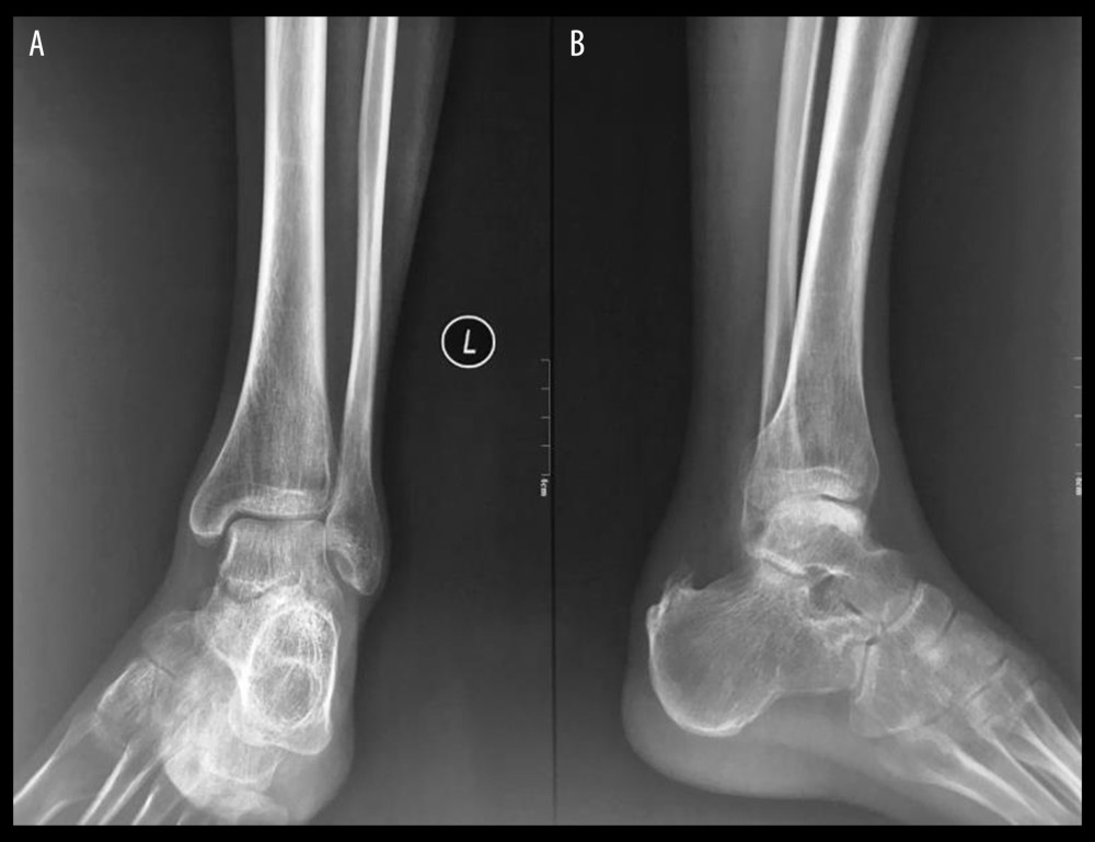 (A, B) Side view of an ankle radiograph of a patient showing Haglund deformity before surgery.