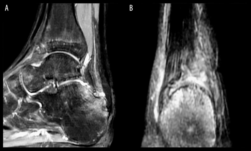 Ankle MRI of a patient with Haglund deformity before surgery. (A) Sagittal image showing the distal side of the Achilles tendon. (B) Coronal image.