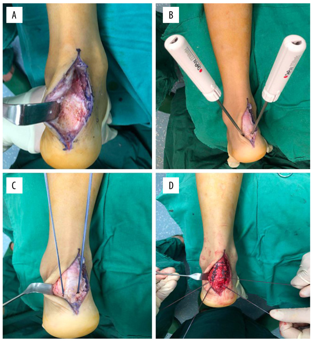 Suture using suture anchor. (A) The Achilles tendon was completely separated, and the calcaneus protrusion was removed. (B) Two suture anchors were inserted. (C) The tendon was repaired with double-row suture. (D) Suturing was complete.